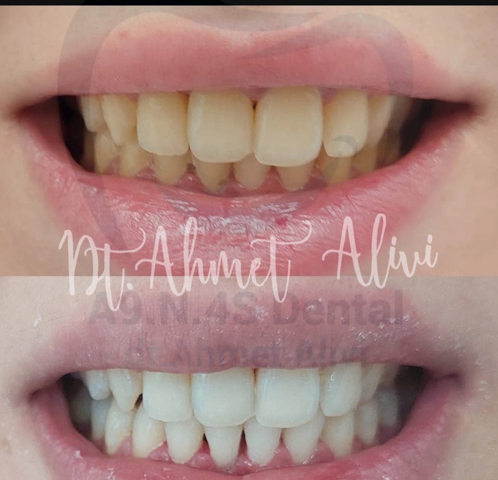 Patient smile transformation before and after #1 — Dr. Alivi Dental Clinic Istanbul