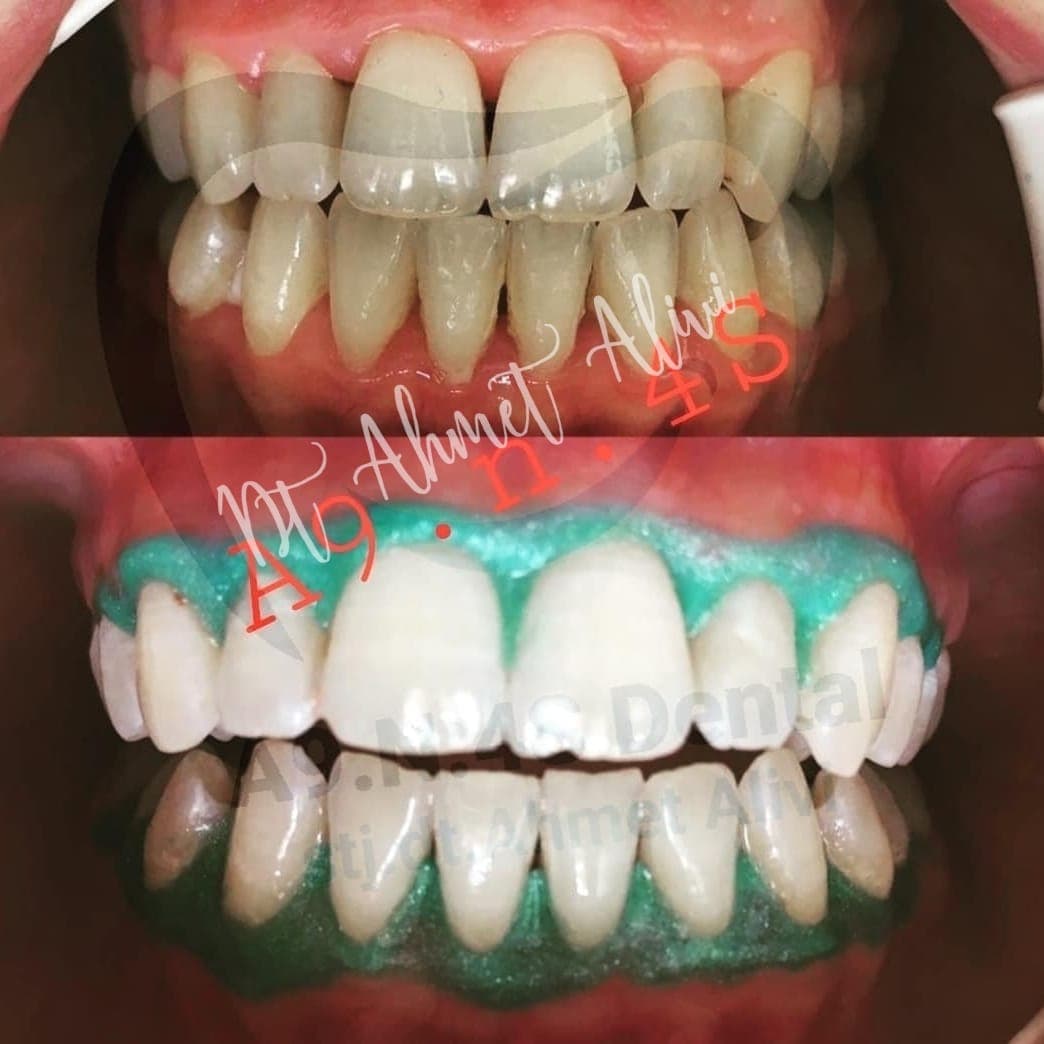 Patient smile transformation before and after #2 — Dr. Alivi Dental Clinic Istanbul