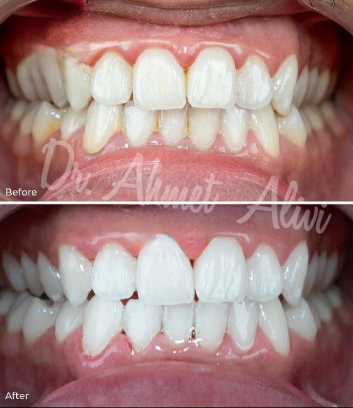 Patient smile transformation before and after #7 — Dr. Alivi Dental Clinic Istanbul