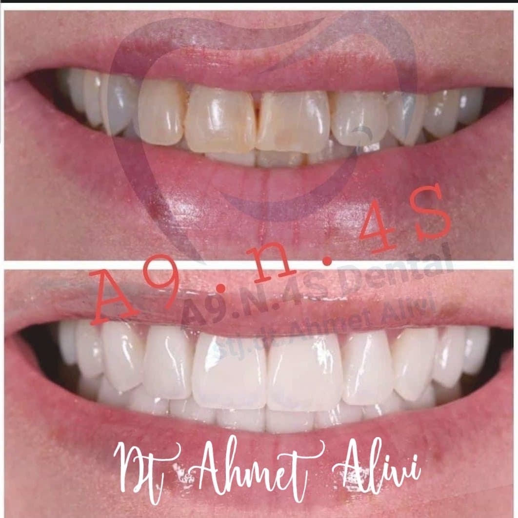 Patient smile transformation before and after #8 — Dr. Alivi Dental Clinic Istanbul